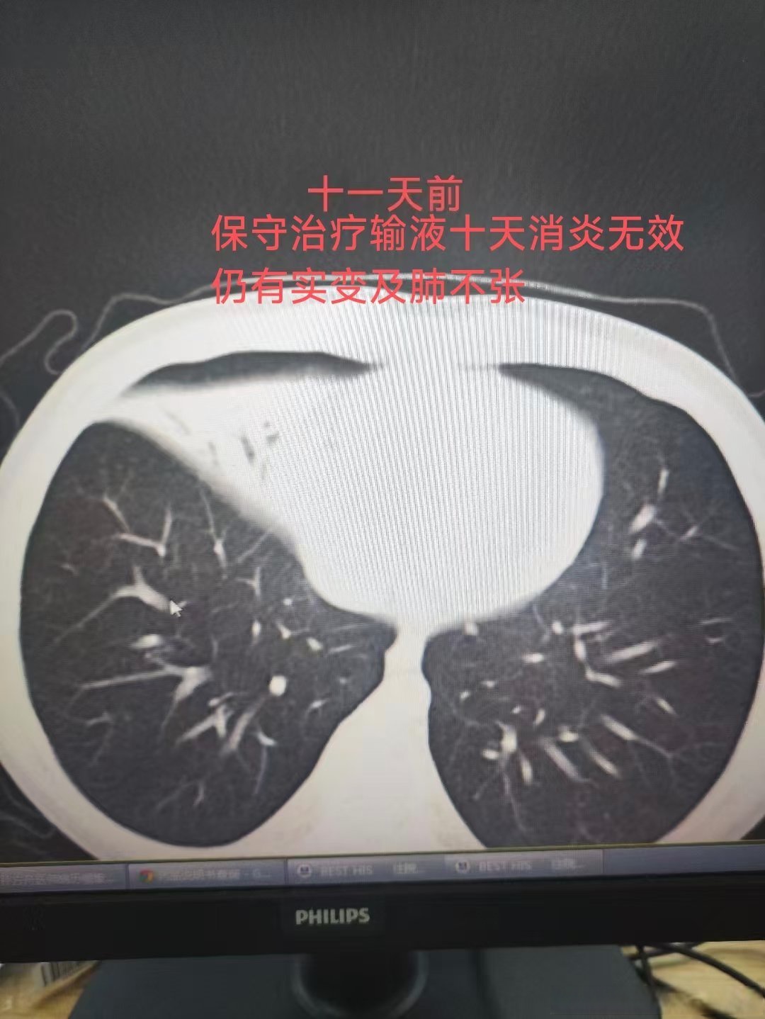 「黑龙江肺炎最新消息」〃黑龙江肺炎病例详情-第3张图片