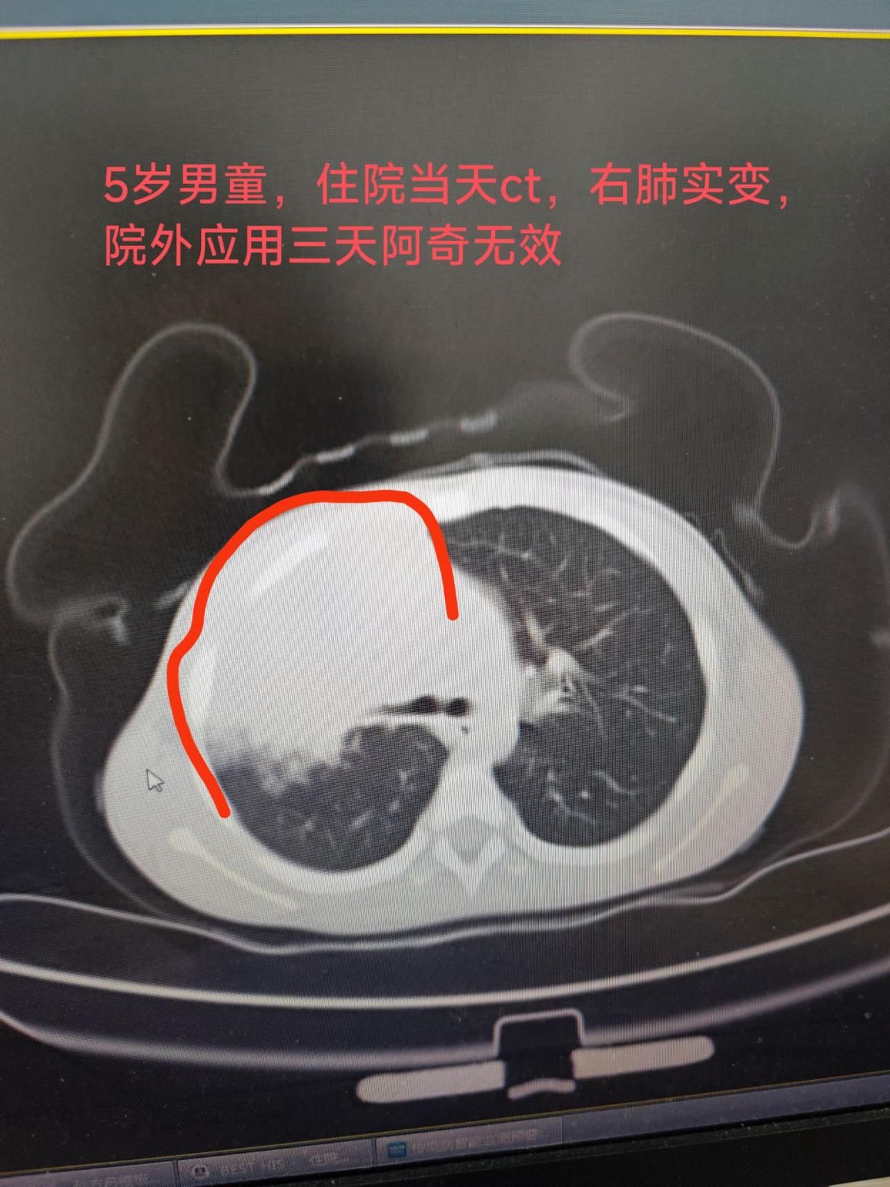 【新疆肺炎/新疆确诊肺炎】-第1张图片